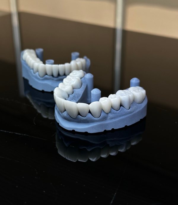 Corone in zirconia sui modelli delle due arcate