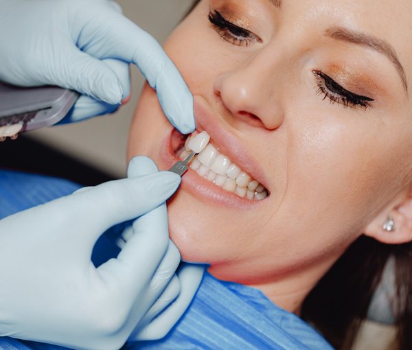 Una paziente sorride mentre il dentista prova una faccetta